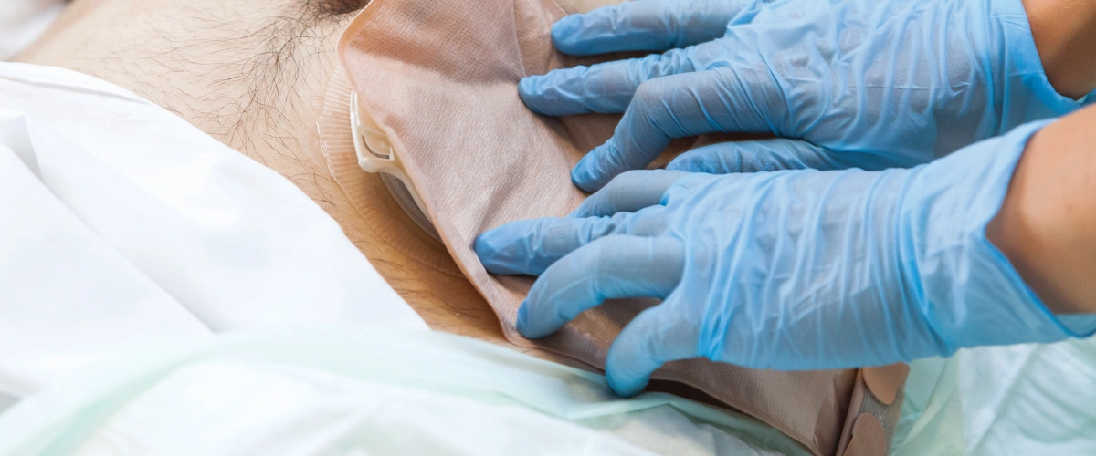 Infermiere che assiste un paziente nella gestione della stomia