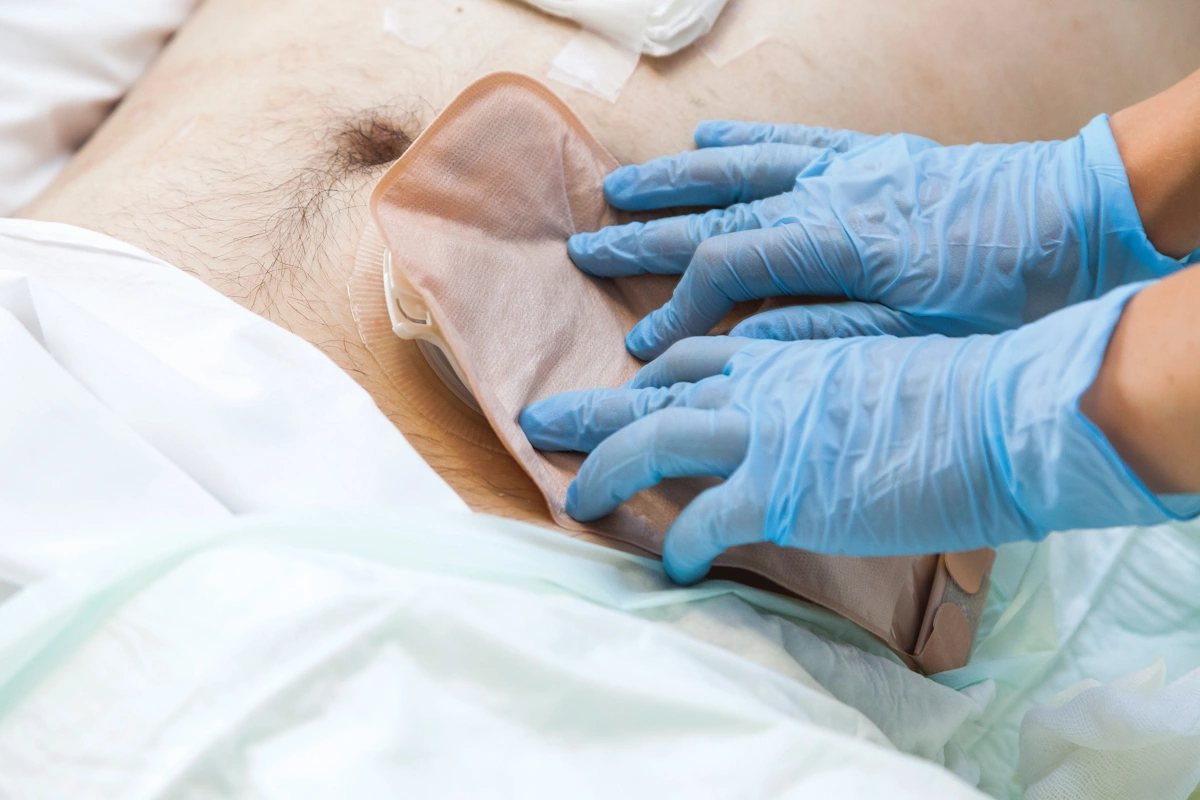 Gestione delle Stomie: Cambio della Placca e del Sacchetto