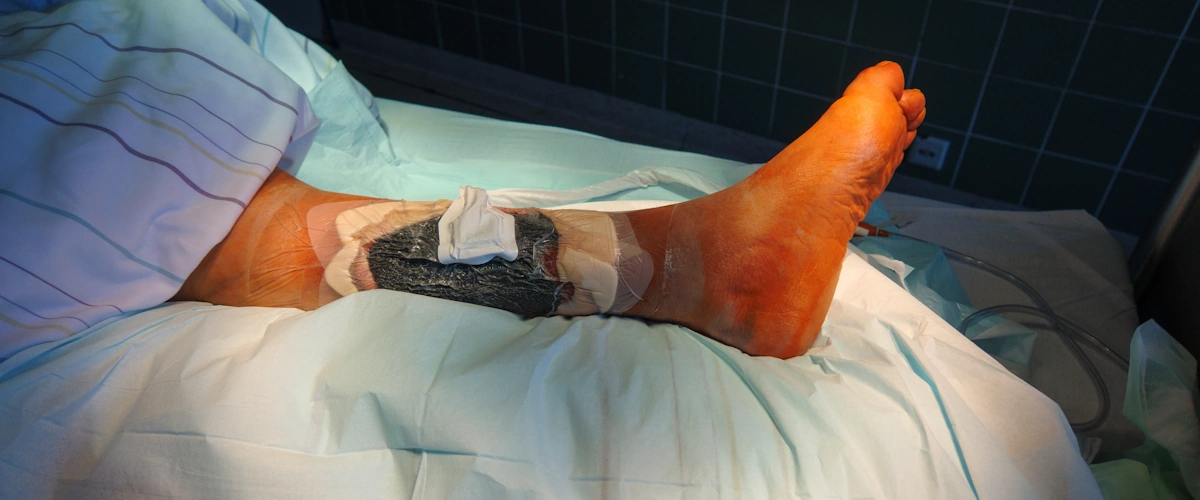 Dispositivo di terapia a pressione negativa applicato a una ferita